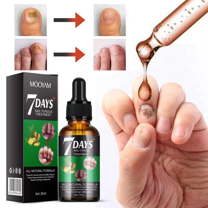 7 Days Nail Fungus Treatment – Sérum Antimycosique Ultra - Rapide pour Ongles Sains (Pour pieds et mains) - SamaShop