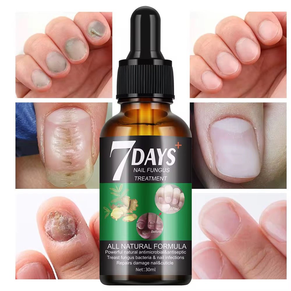 7 Days Nail Fungus Treatment – Sérum Antimycosique Ultra - Rapide pour Ongles Sains (Pour pieds et mains) - SamaShop