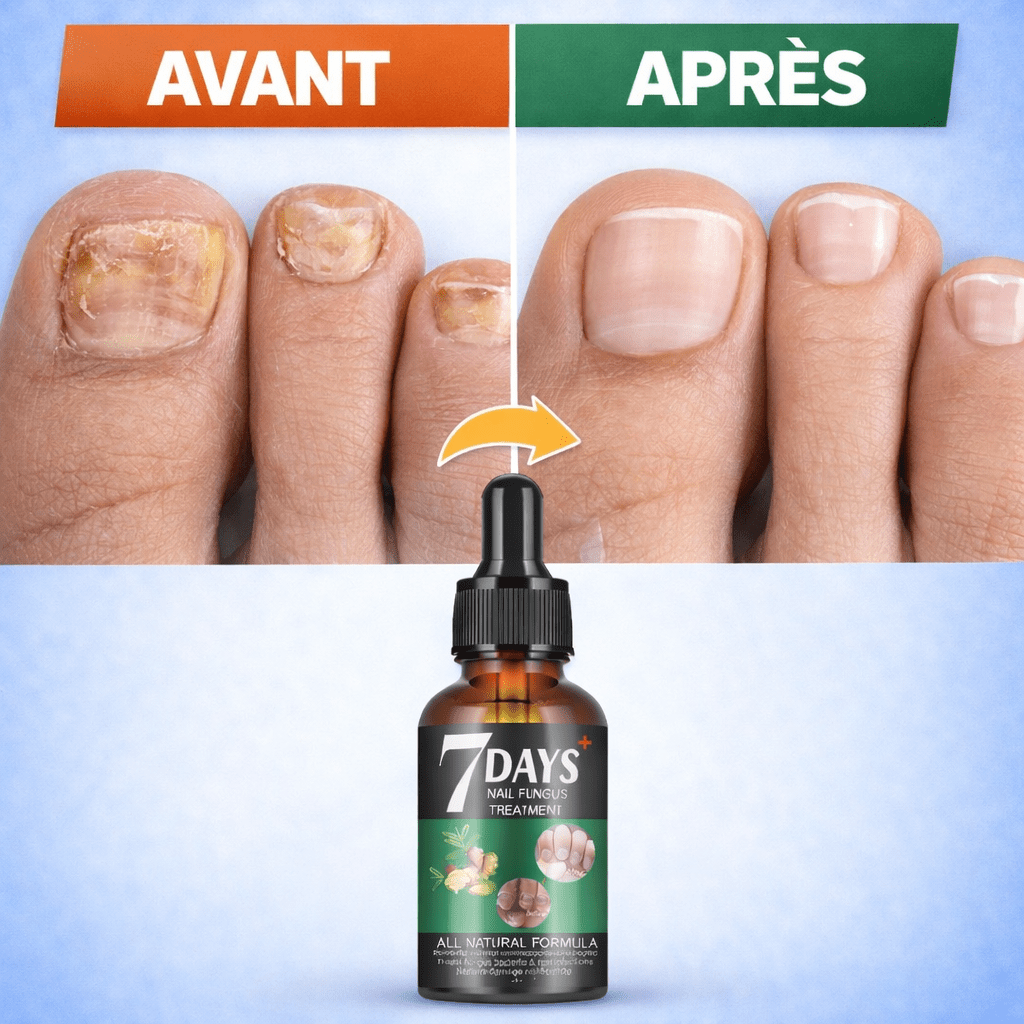 7 Days Nail Fungus Treatment – Sérum Antimycosique Ultra - Rapide pour Ongles Sains (Pour pieds et mains) - SamaShop