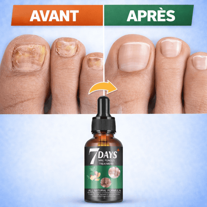7 Days Nail Fungus Treatment – Sérum Antimycosique Ultra - Rapide pour Ongles Sains (Pour pieds et mains) - SamaShop