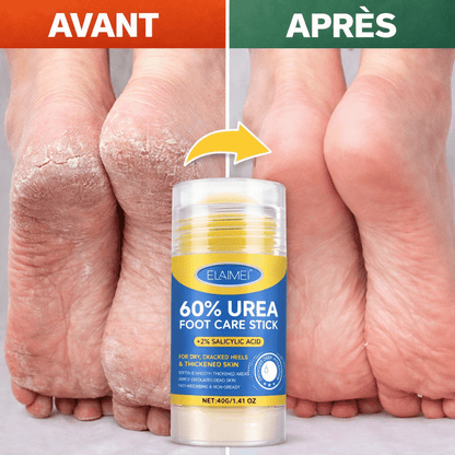 Crème pour les pieds á l'urée á absorption rapide pour soin des pieds (Ultra efficace pour pieds craquelés) - SamaShop