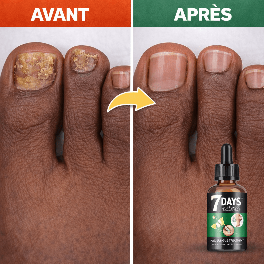 Sérum Anti - Mycose Ongles – Résultats Visibles, Pieds & Mains (1 acheté = 1 offert) - SamaShop