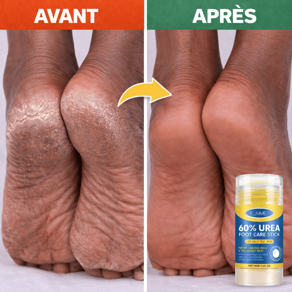 Crème pieds pour soin des pieds ( 1 acheté = 1 crème pour pieds secs offerte ) - SamaShop