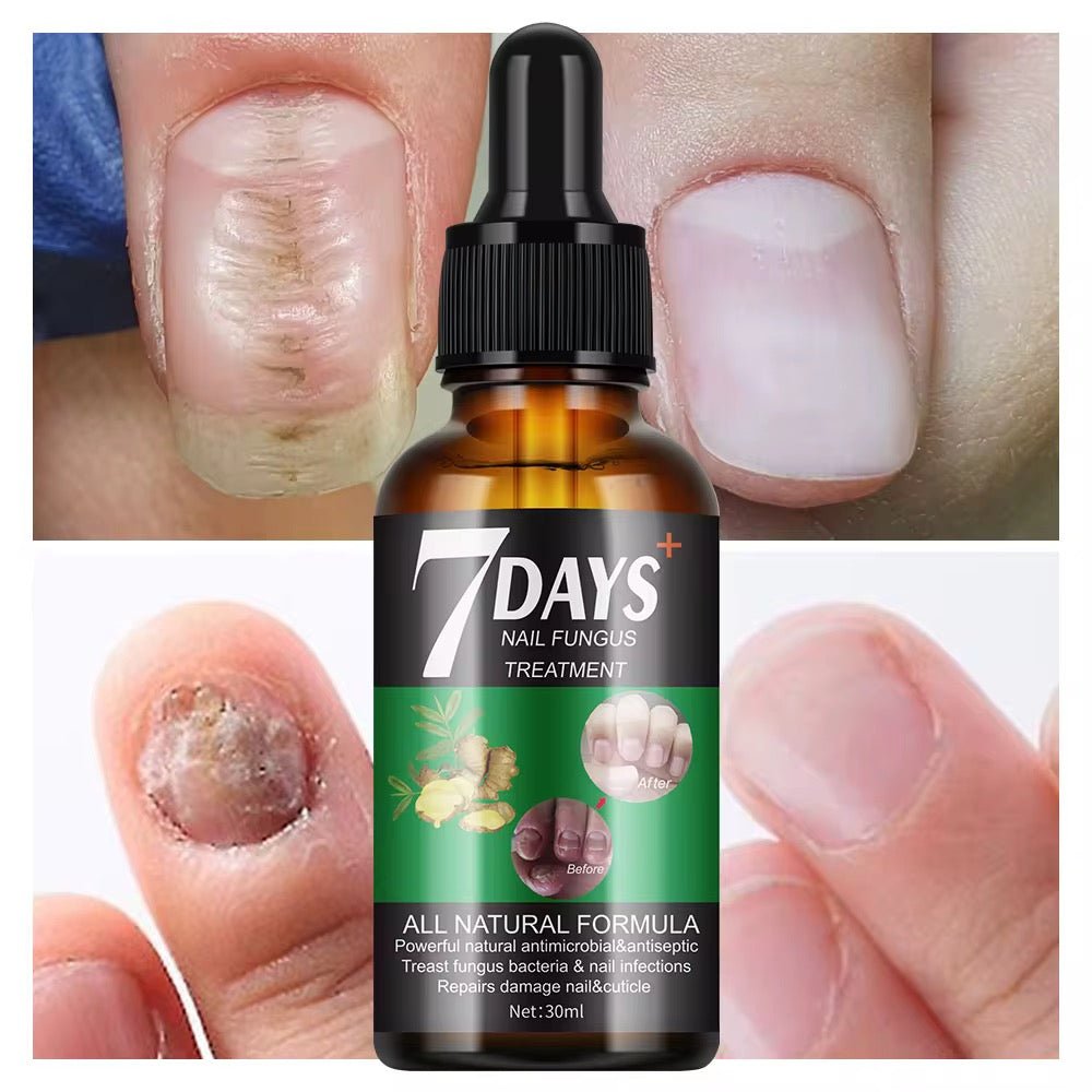 7 Days Nail Fungus Treatment – Sérum Antimycosique Ultra - Rapide pour Ongles Sains (Pour pieds et mains) - SamaShop