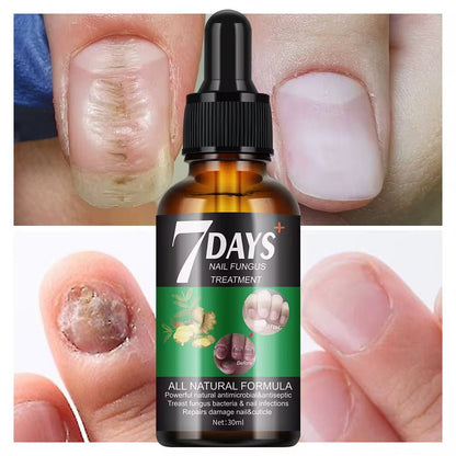 7 Days Nail Fungus Treatment – Sérum Antimycosique Ultra - Rapide pour Ongles Sains (Pour pieds et mains) - SamaShop